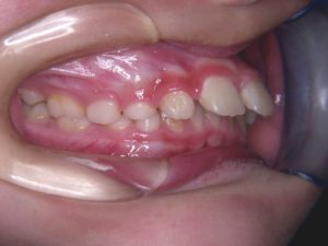 つくば・土浦の矯正歯科　つるみ矯正歯科　歯並び矯正症例D　上顎前突（出っ歯）